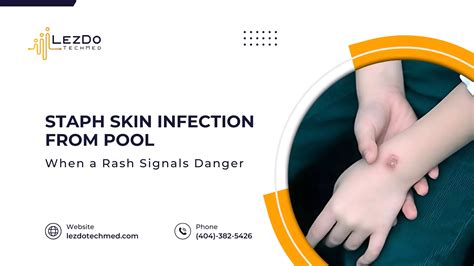 Staph Skin Infections from Pool: When a Rash Signals Danger