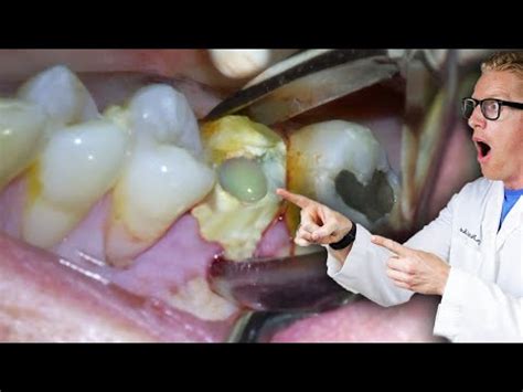 Infected Tooth Extraction Procedure 的图像结果