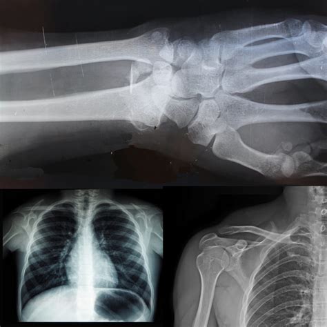 X Rays Examples The Radiology Assistant : Chest X Ray Basic
