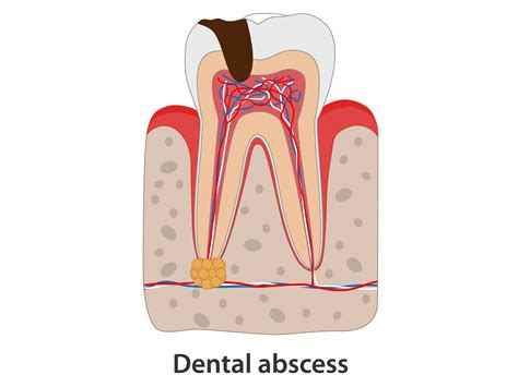 Sterling Smiles Azle | How Can I Get Rid of an Abscessed Tooth at Home?