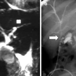 Image result for MRCP Biliary Tree