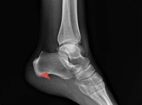 Heel Spur X Ray