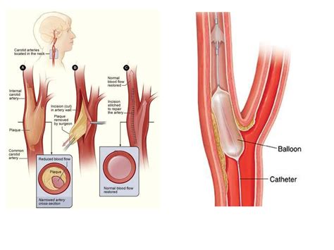 Image result for CVA Recovery