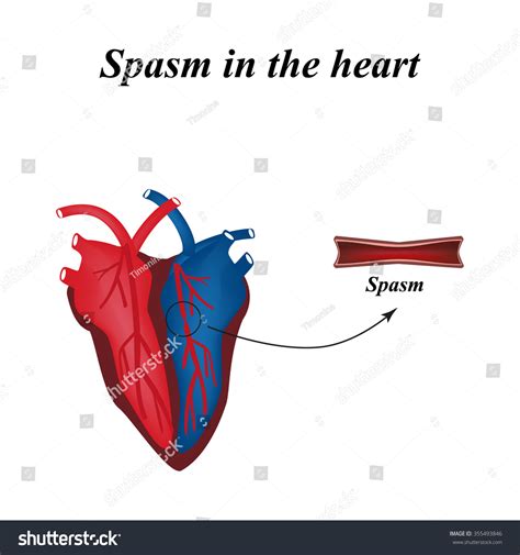 Coronary Spasm: Over 18 Royalty-Free Licensable Stock Vectors & Vector Art | Shutterstock