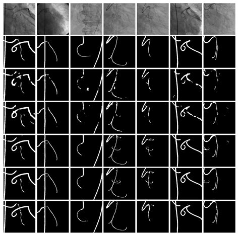 Synthesize and Segment: Towards Improved Catheter Segmentation via ...