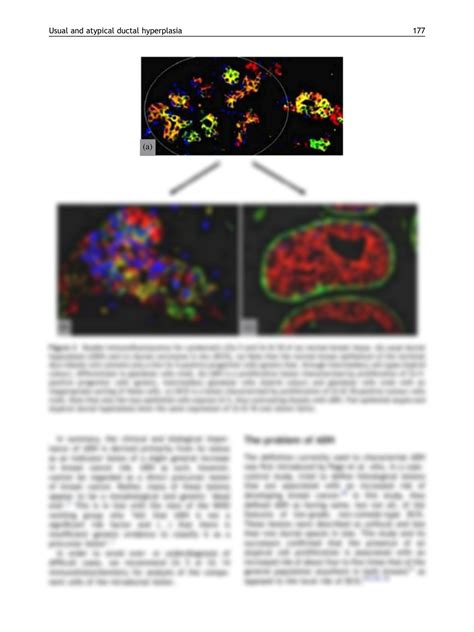 SOLUTION: Usual and atypical ductal hyperplasia me - Studypool