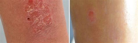 Ultra Healing Cream (for Dry/ Cracked skin, Psoriasis or Eczema Patche ...