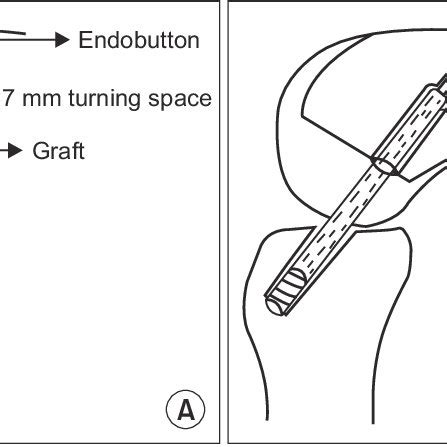 Image result for Transnasal Loop Fixation