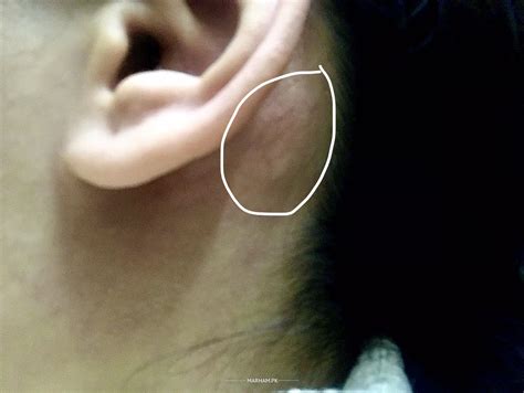 Ask a Ent Specialist Online for Enlarged Bone Behind Ear