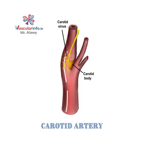 Carotid Body Tumor - Vascular Info