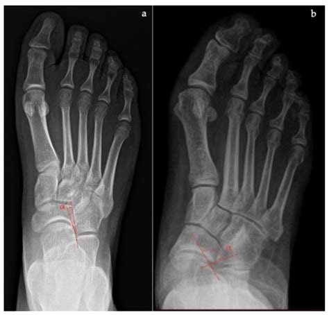 Normal Foot 的图像结果