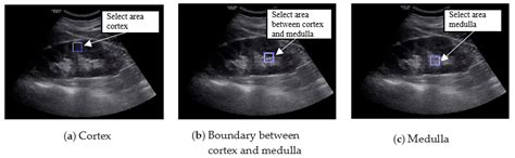 Classification of Chronic Kidney Disease in Sonography Using the GLCM ...
