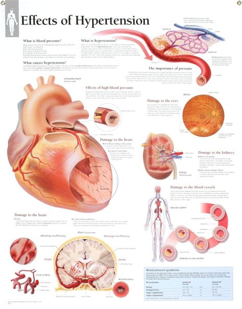 Buy Effects of Hypertension chart: Laminated Wall Chart Wall Chart ...