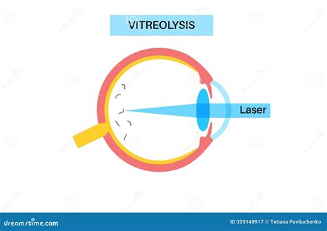 Vitreolysis Laser Treatment Stock Illustration - Illustration of optical, vision: 335148917