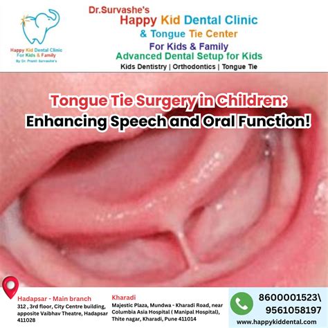 Tongue Tie Surgery in Children: Enhancing Speech & Oral Function! | by Drpranilsurvashe | May ...