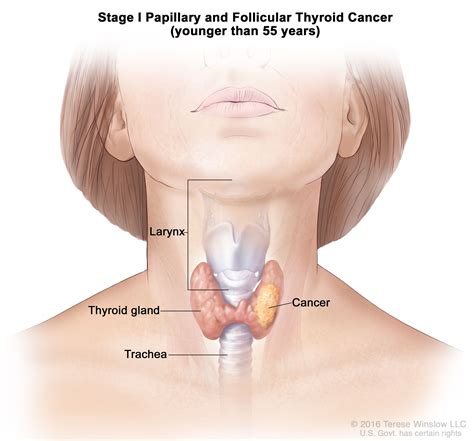 Thyroid Cancer Treatment
