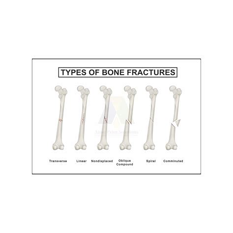 Anne Print Solutions® Types of bone fracture poster (Without Frame) For ...