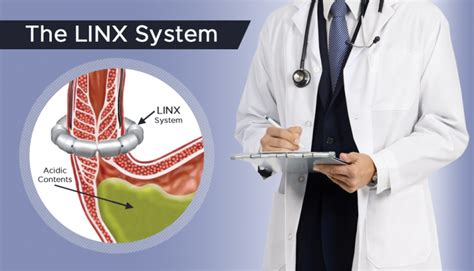 Image result for Linx Procedure Recovery
