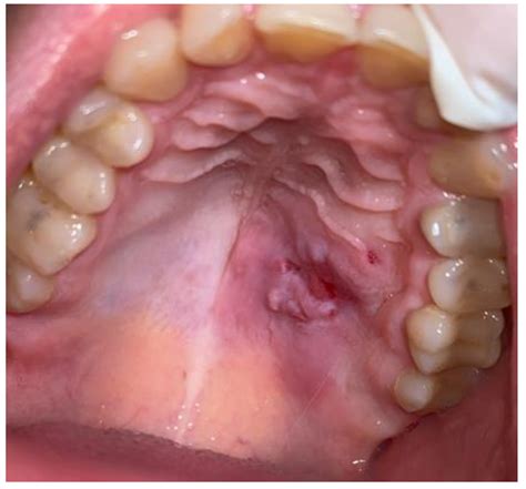 Traumatic Neuroma of the Hard Palate Mimicking a Small Salivary Gland Tumor—A Case Report