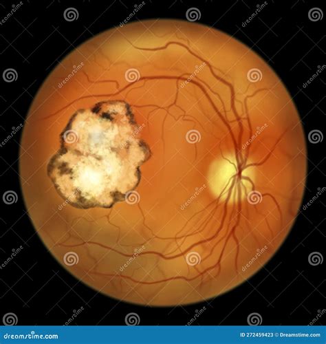 Retinal Scar Caused By A Toxoplasma Gondii Infection, Or Toxoplasmosis ...