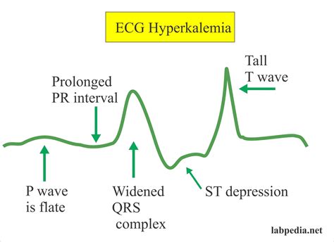 Potassium Ecg Changes at Norma Shanks blog