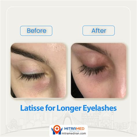 Want Longer Lashes Lets Talk Latisse