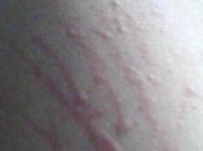 不只是皮肤问题 身上痒痒预示10种大病_青岛频道_凤凰网
