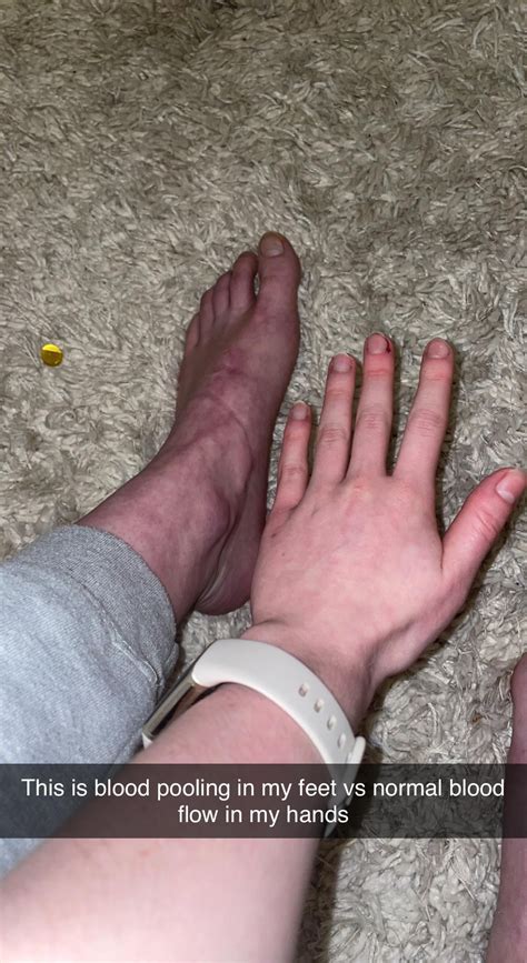 Is this considered normal blood pooling? : r/POTS