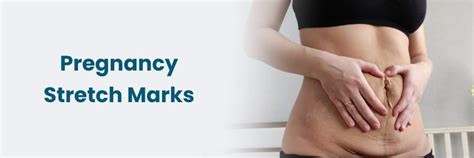 Managing Pregnancy Stretch Marks