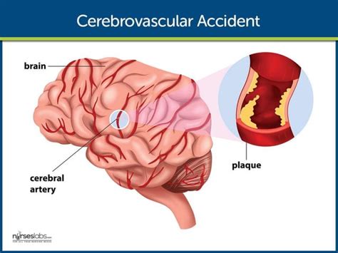 Image result for CVA Recovery