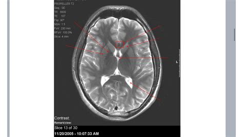 Brain CT Scan 的图像结果