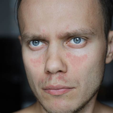 Wichtige Neuerungen im Management von SLE und APS - Rheumatologie ...