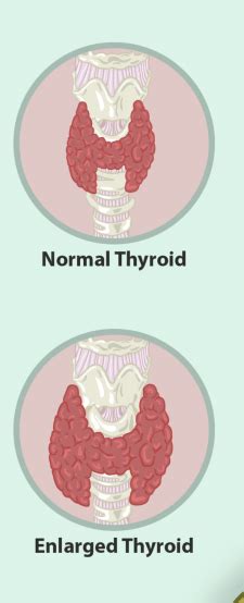 Image result for hyperthyroidism