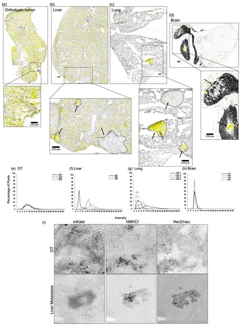 Inter-Metastatic Heterogeneity of Tumor Marker Expression and ...
