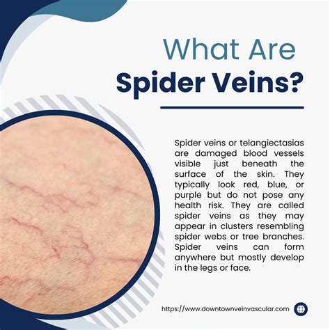 How to Treat Spider Veins on Your Face