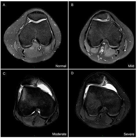 Tibial Tubercle to Trochlear Groove Distance Measured by Posterior ...