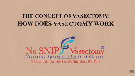 Videos - Vasectomy Specialist