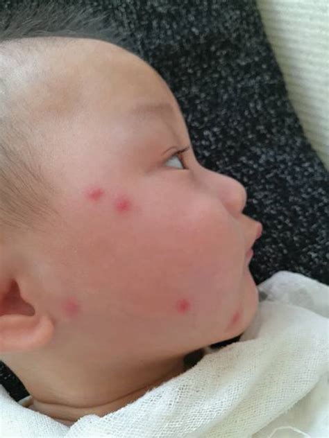 儿童脸上有红点图片_白血病初期针孔小红点图片 - 随意云