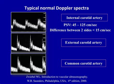 Doppler ultrasound of carotid arteries | PPTX