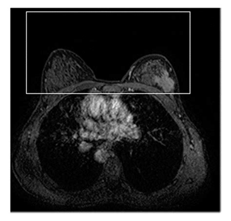 Breast Cancer Mass Detection in DCE–MRI Using Deep-Learning Features ...