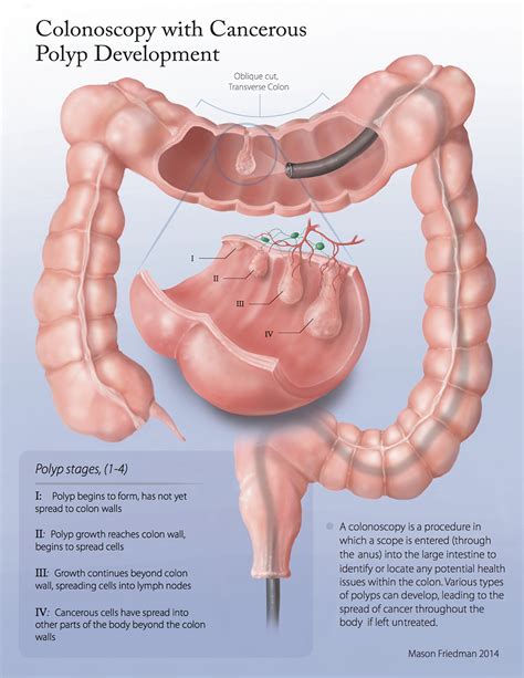 Image result for Colonoscopy Polyps Types