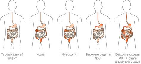 Что такое болезнь Крона и сколько стоит ее лечить
