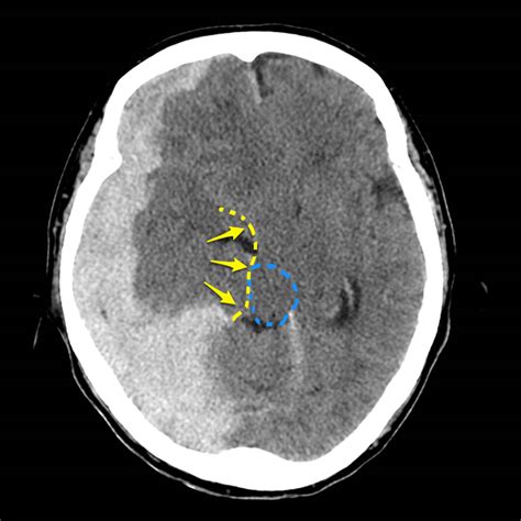 Midline shift brain causes, symptoms, diagnosis & treatment