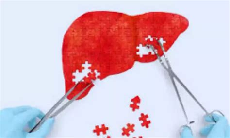 MRI Outperforms Ultrasound in Detecting Liver Cancer During Cirrhosis ...