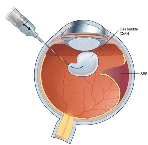 Retinal Detachment Surgery