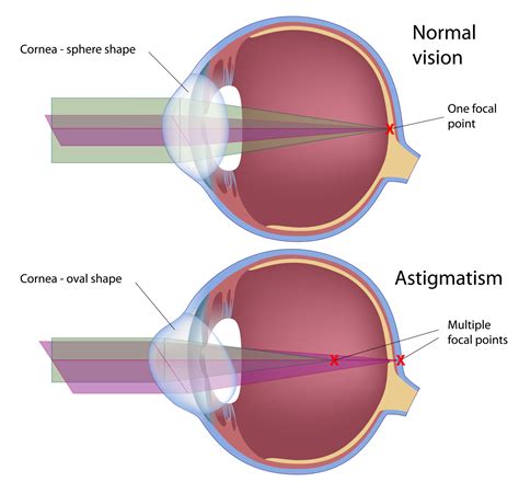 Astigmatism Lights (What People w/ Astigmatism See at Night)