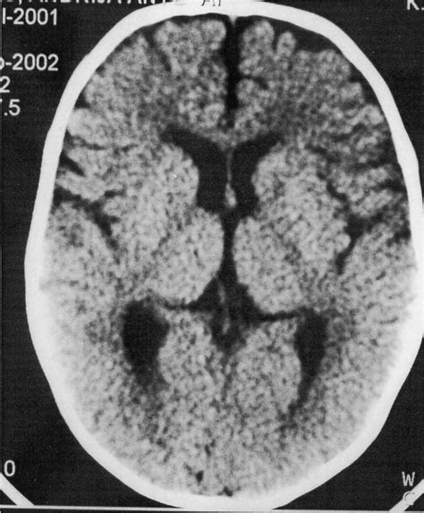 Image result for Diffuse Atrophy
