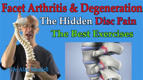 Facet Arthritis & Degeneration (The Hidden Disc Pain) Best Exercises ...
