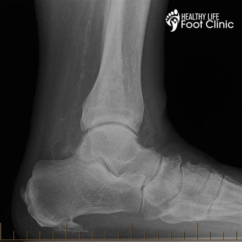 Heel Spurs Explained: Causes, Symptoms & Treatment Options