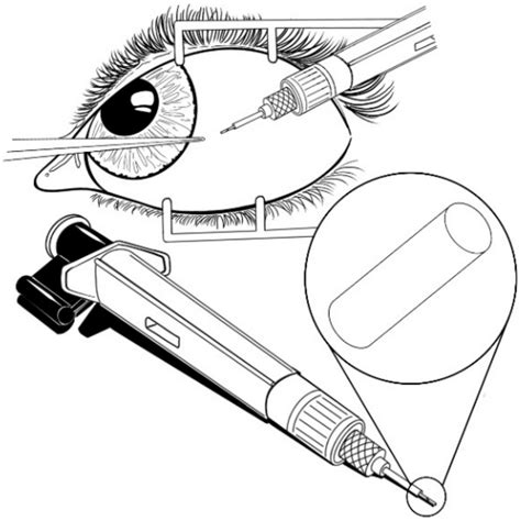 Polymeric Implants for the Treatment of Intraocular Eye Diseases ...